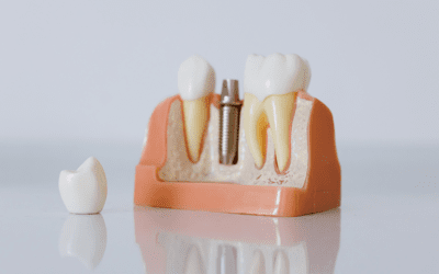 5 Misconceptions That Might Keep You from Getting Dental Implants