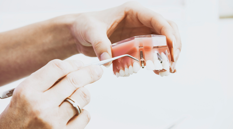 Dental Implant Misconceptions