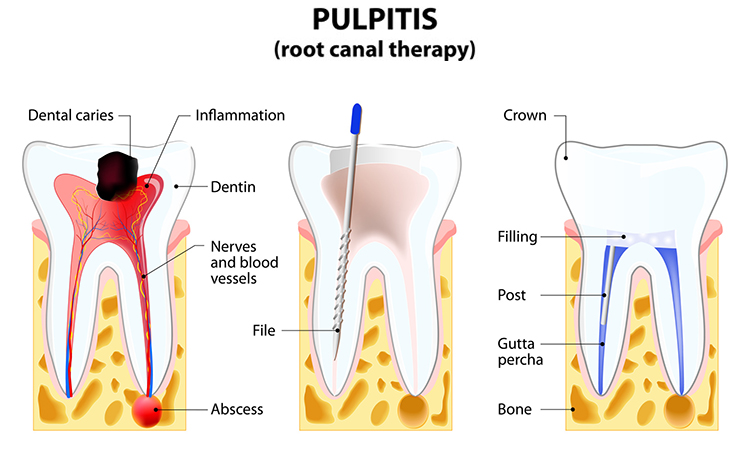 Image of Pulpitis. root canal therapy. Infected pulp is removed from the tooth and the space occupied by it is cleaned and filled with a gutta percha. Post inserted to support crown