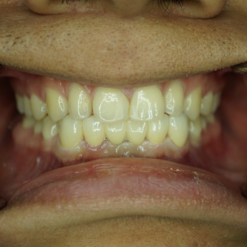 Bridge-on-Lower-Teeth-After-dentist-mira-mesa