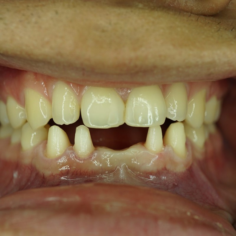 Bridge-on-Lower-Teeth-Before-dentist-mira-mesa