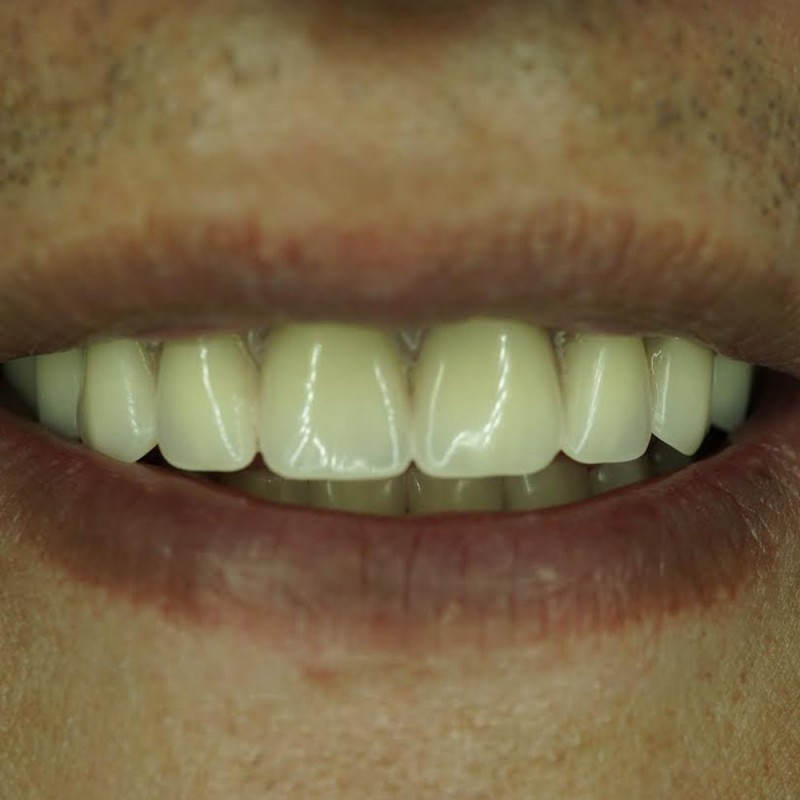 Dentures-after-Mira Mesa Dentist