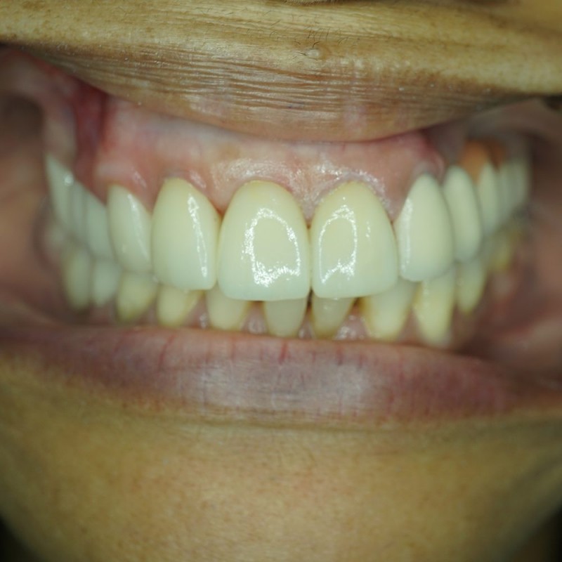 Redoing-Patient-Crowns-After-dentist mira mesa