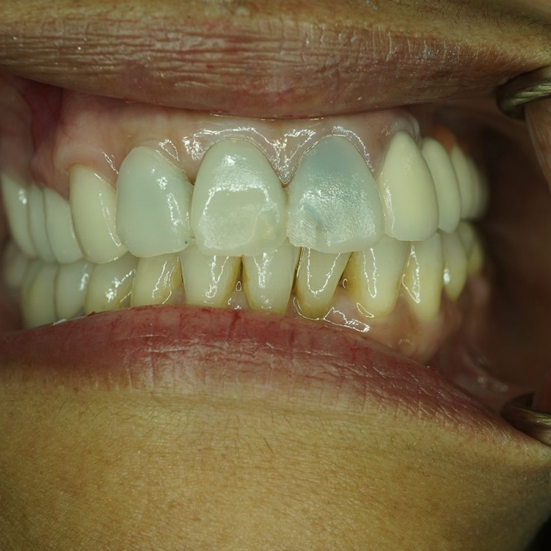 Redoing-Patient-Crowns-Before-Dentist Mira Mesa
