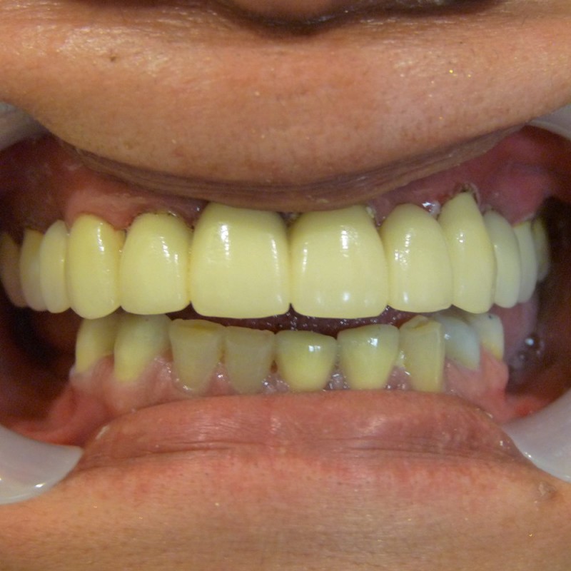 Redoing-Smile-by-Crowns-After-dentist mira mesa
