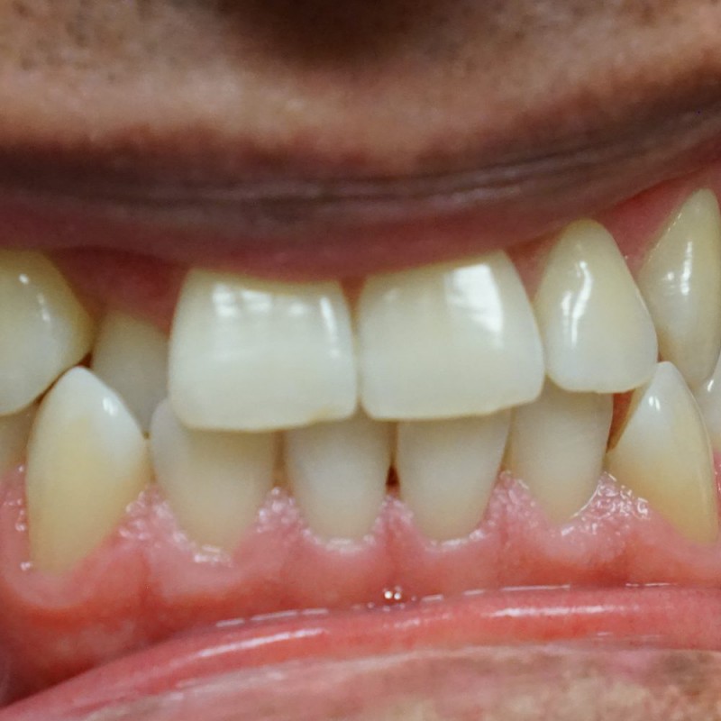 invisalign-before-dentist mira mesa