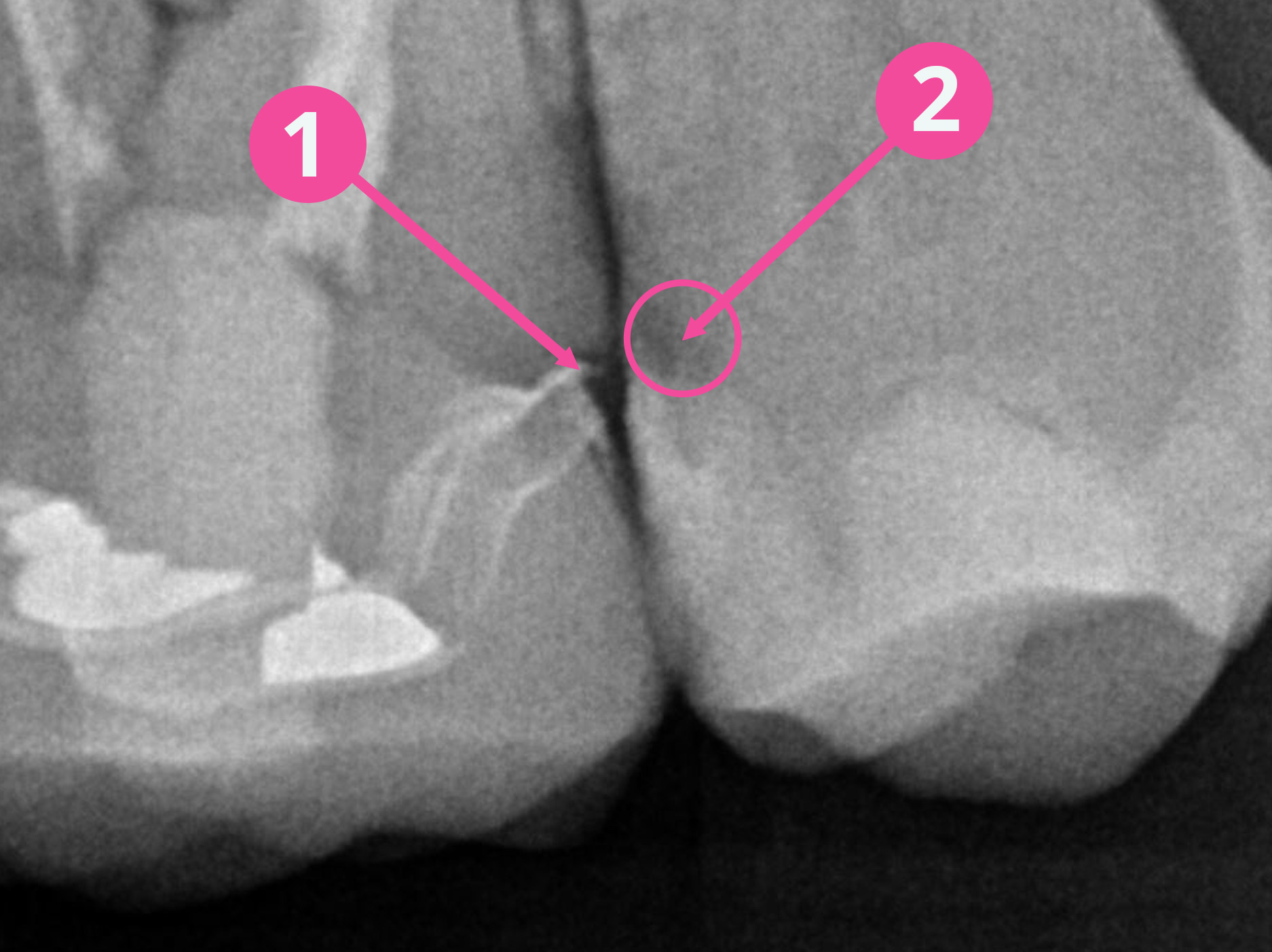 R5 image example of same day crown